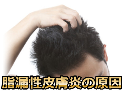 脂漏性皮膚炎の原因