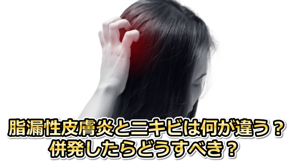 脂漏性皮膚炎とニキビ